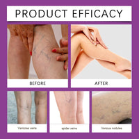 SONGQEE Soothing Leg Breathable Care Patches, Varicose Vein Patch, Improving Blood Circulation, Skin Body Care, for All Skin Types