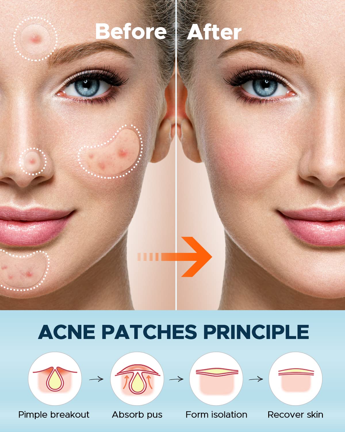 LitBear Pimple Patches, Large Acne Patches for Face, Chin, or Body, Acne Spot with Tea Tree & Calendula Oil, Hydrocolloid Bandages for Acne Skin (100 Patches)