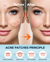 LitBear Pimple Patches, Large Acne Patches for Face, Chin, or Body, Acne Spot with Tea Tree & Calendula Oil, Hydrocolloid Bandages for Acne Skin (100 Patches)