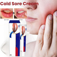Cold Sore Cream,Cold Sore Treatment Cream,Mouth Ulcer Treatment for Adults,Gentle Sore Lips Treatment,Mouth Sore Treatment for Lips,Mouth Ulcer Gel,Fresh and Non-irritating,Natural Ingredients,20g