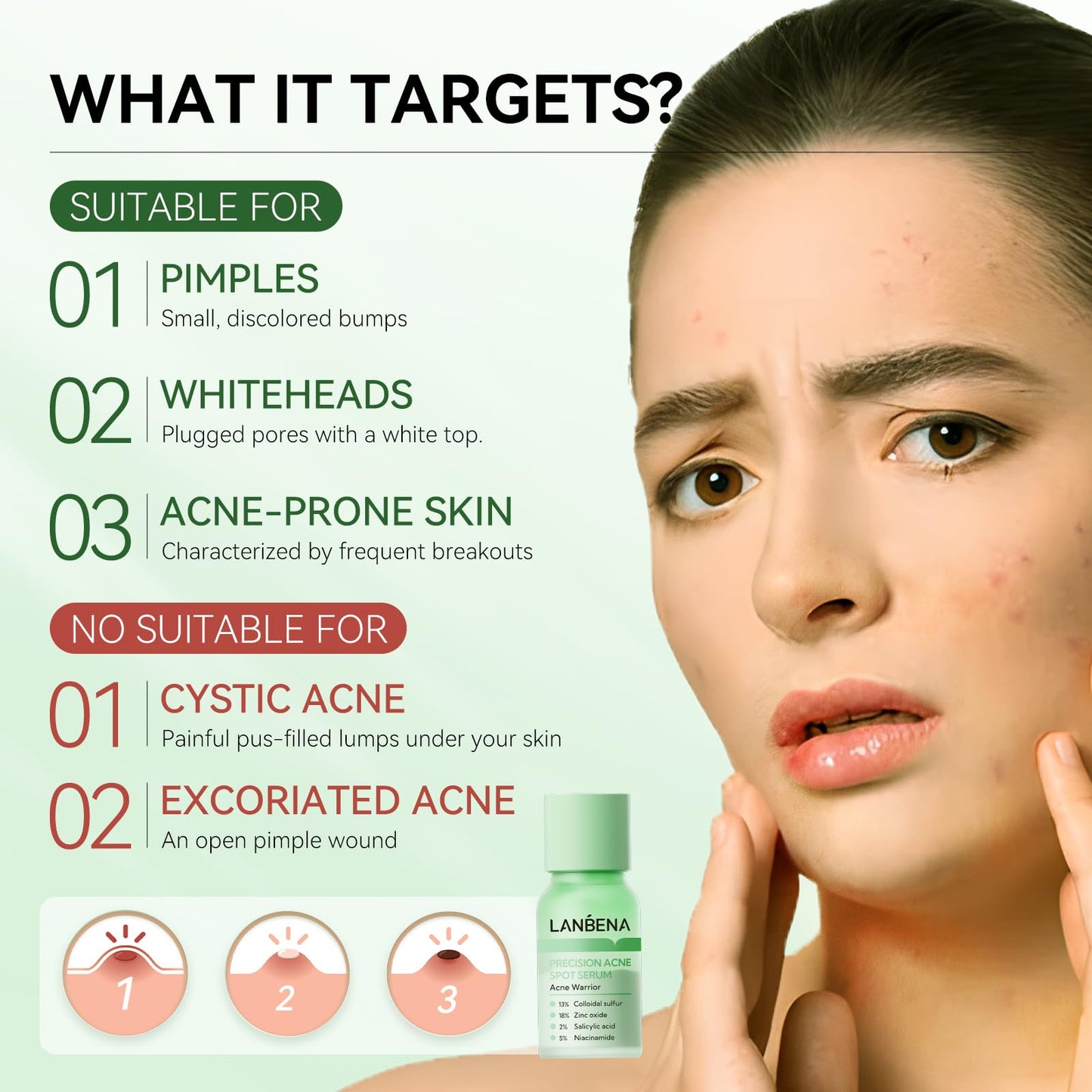 LANBENA Precision Acne Treatment Spot Serum, Drying Lotion, Overnight Acne Treatment For Face, Dry Out Pimples, Blemishes, Zits And Clean Pores, 0.42 Fl Oz (Pack of 1)