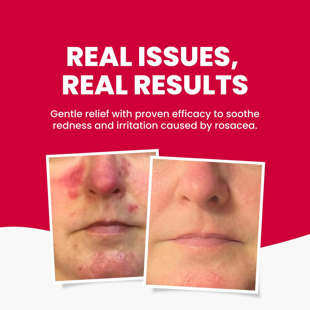 Grahams Natural Anti Redness Face Wash for Rosacea - Facial Cleanser for Redness-Prone, Sensitive Skin (1 x 125ml)
