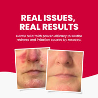 Grahams Natural Anti Redness Face Wash for Rosacea - Facial Cleanser for Redness-Prone, Sensitive Skin (1 x 125ml)