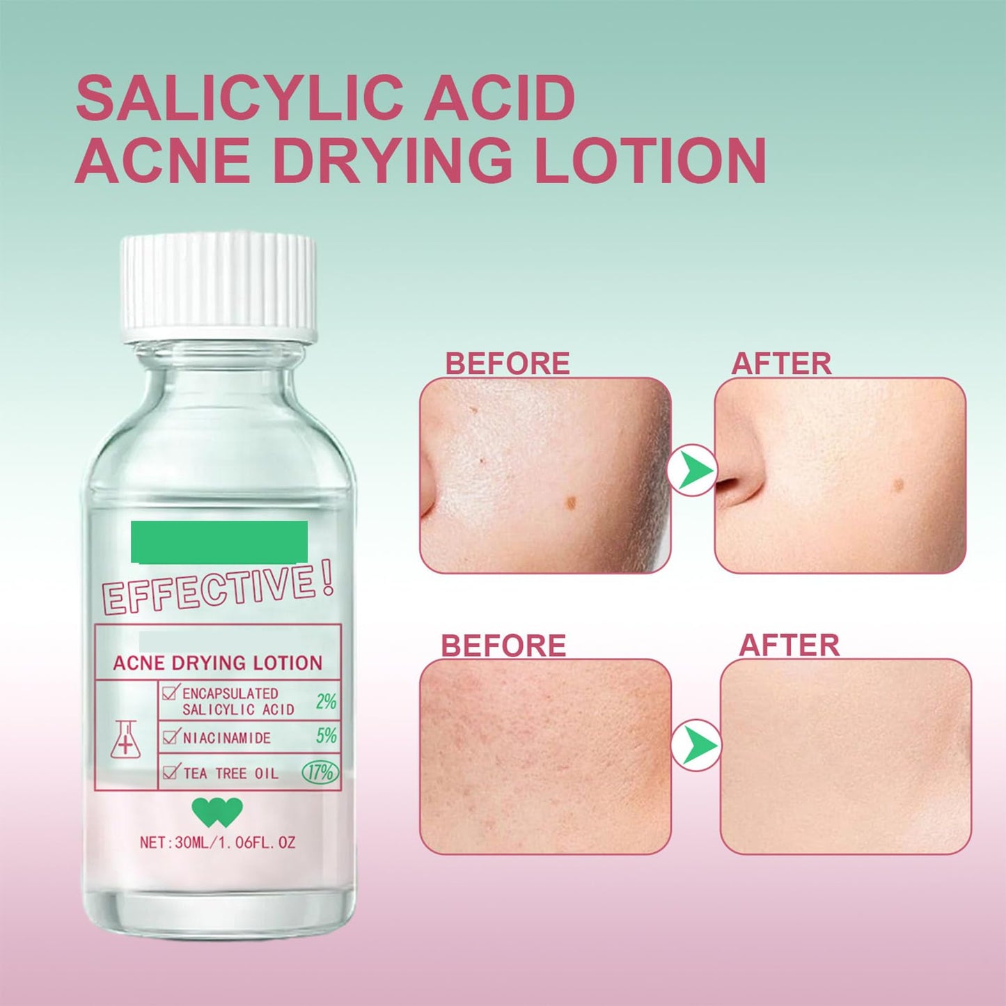 Overnight Drying Lotion, Spot Treatment for Acne, Anti-Blemish Drying Lotion For Blemishes 30ml Anti Acne Treatment Face Serum for Facial Pimples/Zits, Acne Control, Reduce Redness