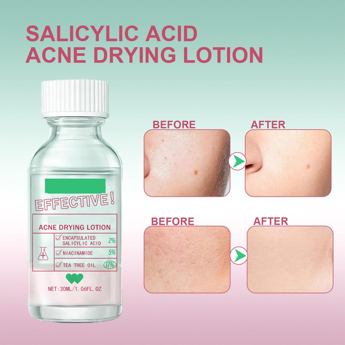 KAYZON Overnight Drying Lotion, Spot Treatment for Acne, Anti-Blemish Drying Lotion For Blemishes 30ml Anti Acne Treatment Face Serum for Facial Pimples/Zits, Acne Control, Reduce Redness