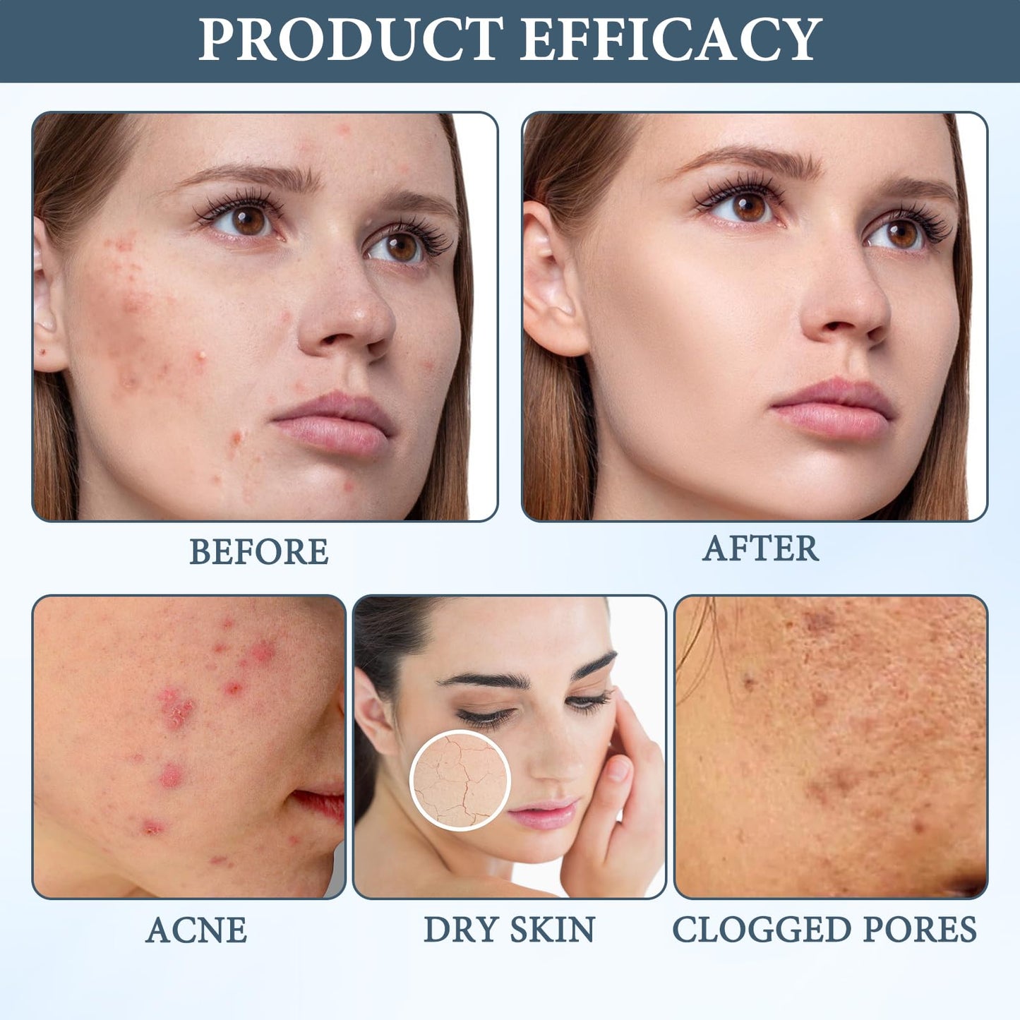 2pcs Norse Acne Organics Balm Cream,Acne Set Clearing Cream for Women & Me Organic Acne Balm, Organics Acne Killer Reduces Acne, Blackheads, Pimples, Removes Excess Oil and Deeply Moisturizes