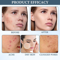 2pcs Norse Acne Organics Balm Cream,Acne Set Clearing Cream for Women & Me Organic Acne Balm, Organics Acne Killer Reduces Acne, Blackheads, Pimples, Removes Excess Oil and Deeply Moisturizes