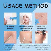 BPTZYLN 200 Pcs Pimple Needle Blackhead Blemish Remover, Milia Removal Needle Blue Tool Cyst Removal, Professional Pimple Popper Remover Tools for Clear Skin, Beauty Salon Home Sterile Needles for Cysts