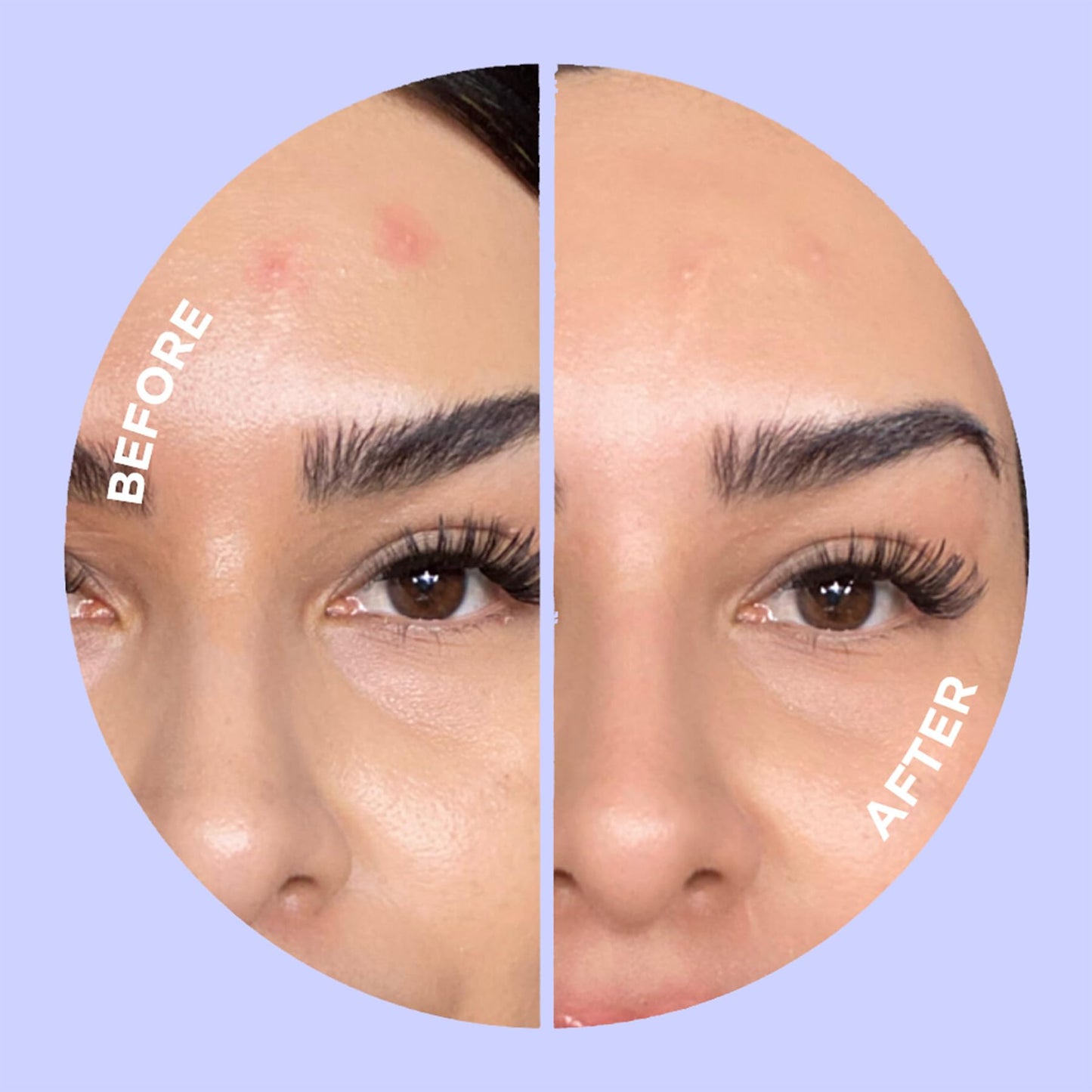 ZitSticka UNDERCOVER Blemish Patches