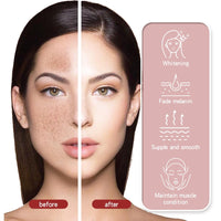 Whitening Freckle Cream,Dark Spot Remover for Face,Freckle Removal Cream,Acne Scar Removal Treatment Crea/m,Skin Lightening Cre/am for Dark Skin,Dark Spot Corrector Cr/eam,Spot C/ream for Women & Men