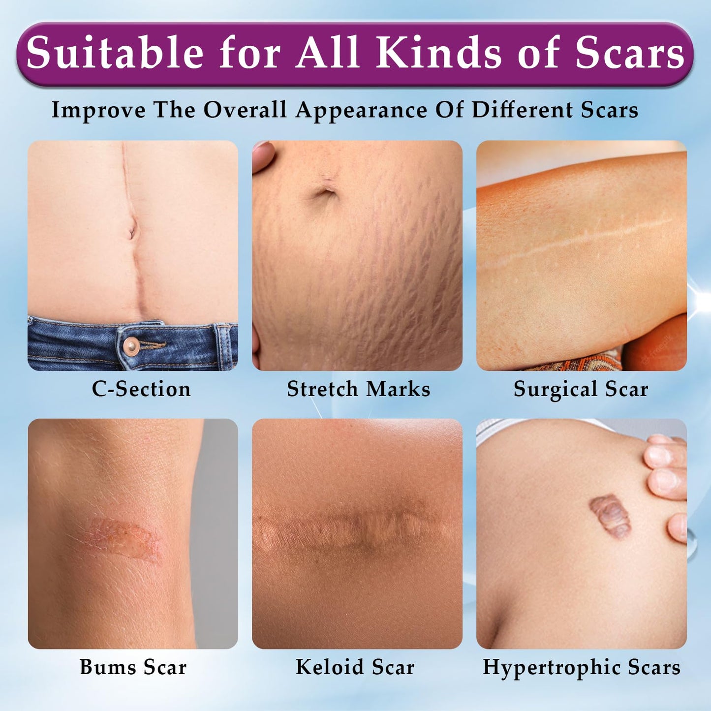 Eveellyn Scar Cream, Scar Gel, Professional Scar Removal Cream for Surgical Scars, Stretch Mark, Keloid Bump, C-Section, Burn, Acne, Old and New Scars 1.7 oz (50g)