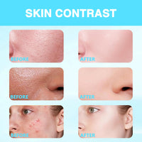 Bettinay 6PCS Lips Serum Beauty Kit, Micro Infusion Facial System for Deep Nourishment All Skin Types