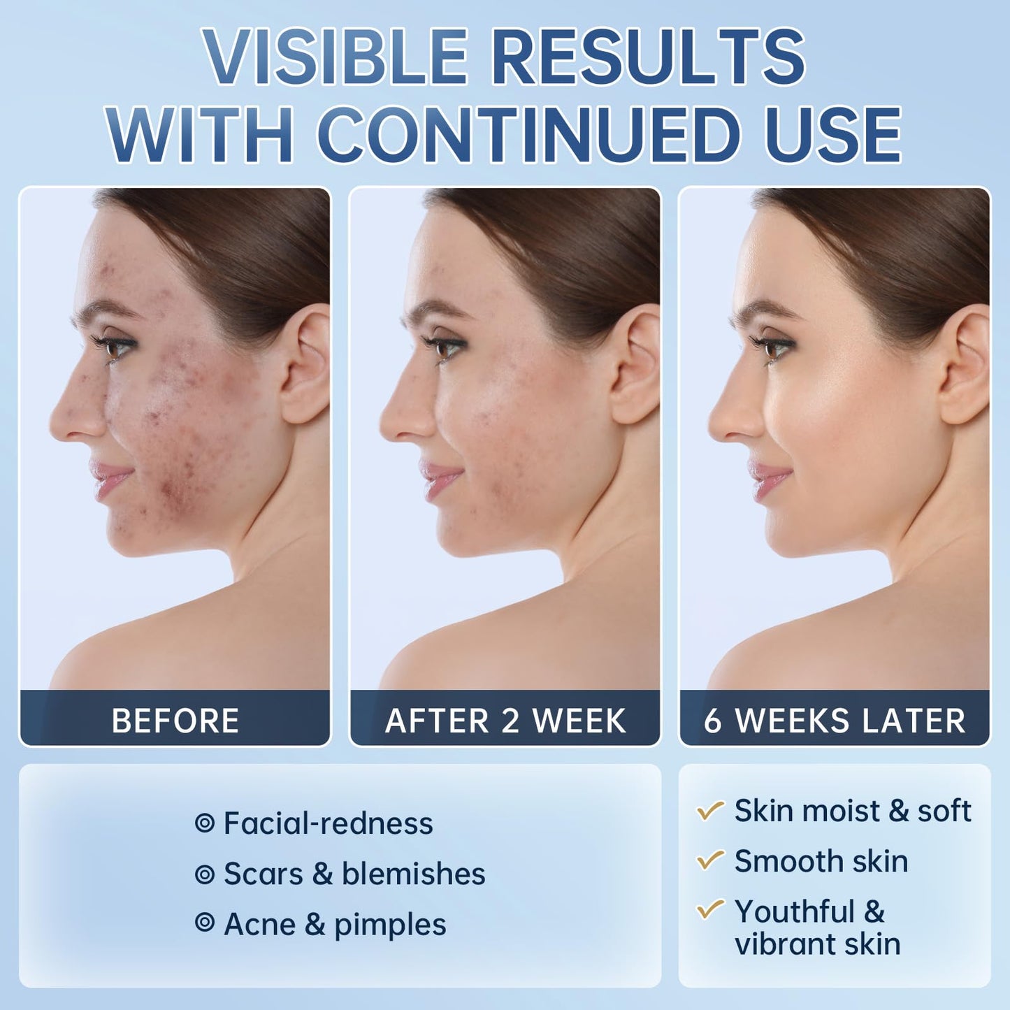 BECHOICEN Azelaic Acid face serum cream for Redness Relief,Dark Spots,Azelaic Acid Acne Cream with Niacinamide & Vitamin C,Acid 14% Facial Serum Balance Excess Sebum & Soothe Irritation,30ml