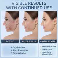 BECHOICEN Azelaic Acid face serum cream for Redness Relief,Dark Spots,Azelaic Acid Acne Cream with Niacinamide & Vitamin C,Acid 14% Facial Serum Balance Excess Sebum & Soothe Irritation,30ml