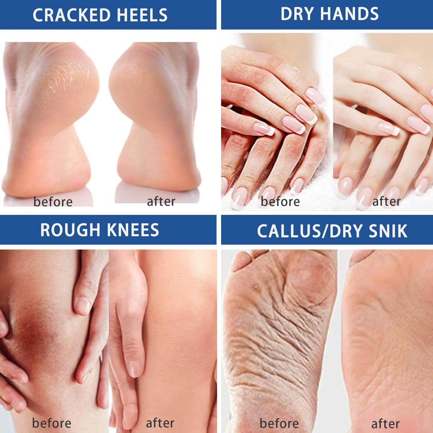 45% Urea Cream - Urea Foot Cream Plus 2% Salicylic Acid - Maximum Strength Urea Cream For Feet Nourish - Foot Urea Moisturiser For Dry Cracked Feet - Soften Calluse Foot Care Cream