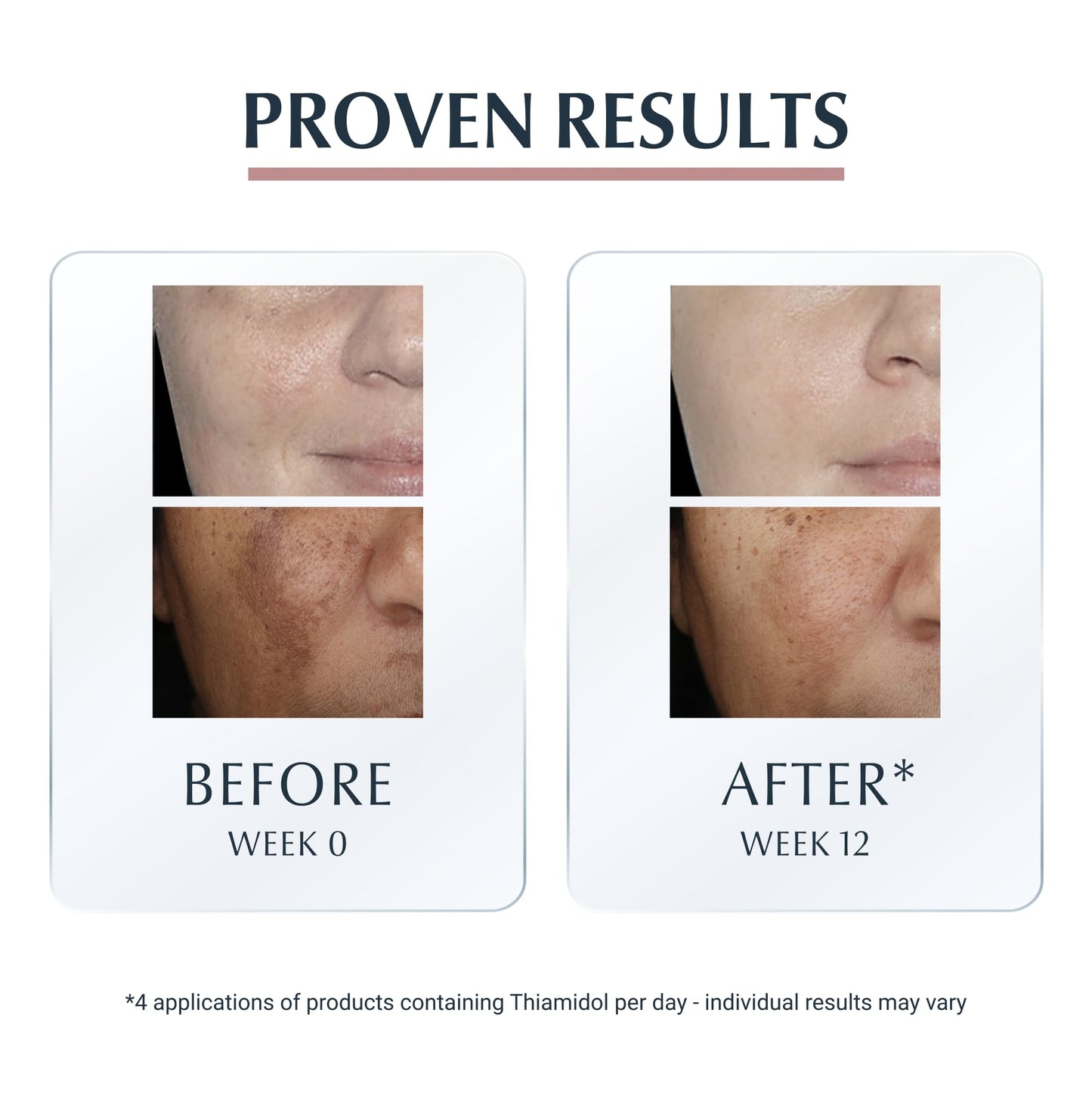 Eucerin Anti-Pigment Dual Serum 30ml, Anti-Pigment Serum for Treatment of Age Spots and Uneven Skin Tone, Advanced Skincare Serum with Hyaluronic Acid