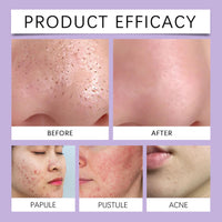 Anti Acne Gel for Face - Face Spot Treatment - Pimple Removal Gel with Tea Tree Oil,Salicylic Acid - Deep Pore Cleansing, Targets Acne, Blackheads & Blemishes, Hydrating Formula 40g