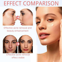 SingHao Aze-laic Acid 15% Acne Tratment Gel,15% Acid Acne Treatment Gel for Face,Azel-aic Acid Cream for Face,Acid Facial Serum,Aze-laic Ac/id Serum Cream with Niacinamide & Vitamin C,Anti Acne G/el for Spot