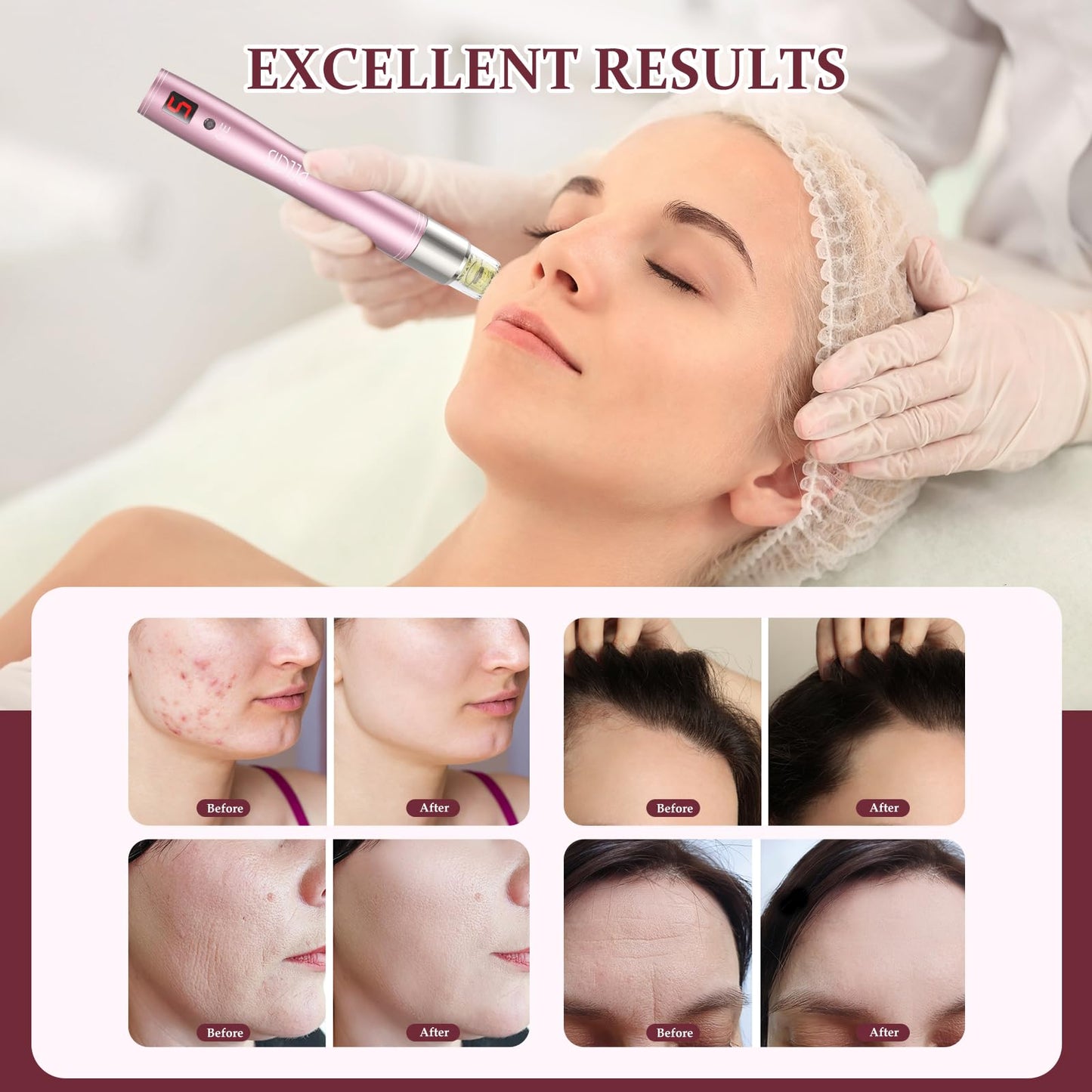 Automatic Serum Applicator Microneedling Pen PELCAS, A3 Electric Derma Pen Level 5 with LCD Screen Rechargeable Cordless Dermapen for Scars,Wrinkles,Stretch Marks,Acne,Skin Rejuvenation(Rose Gold)