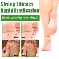 ShengQiu 30pcs Wart Remover,Verruca Treatment,Wart Remover for Hands,Plantar Wart R/emover for Feet,Effective Deep Verruca R/emoval Pads Patches for Adults