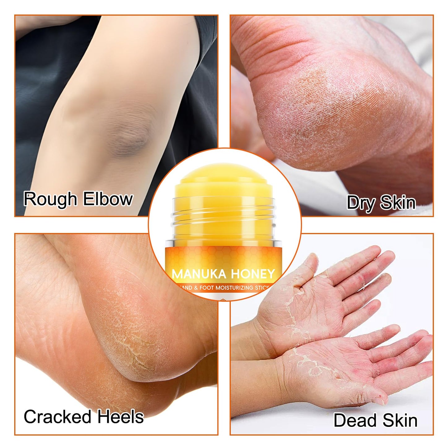 NBXINSLF 60% Urea Cream Foot Care Stick and Manuka Honey Moisturizing Stick, Moisturizer Cream for Dry Cracked Feet, Knees, Elbows, Hands,Moisturizes and Hydrates the Dry Skin,Callus Remover & Skin Softener