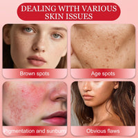 Muiefe 2Pcs Freckle Removal Cream, Dark Spot Remover for Face and Body, Dark Spot Corrector Cream with Vitamin C, E & Niacinamide, Fade Spots Blemishes, Reduces Hyperpigmentation, Improves Skin Tone