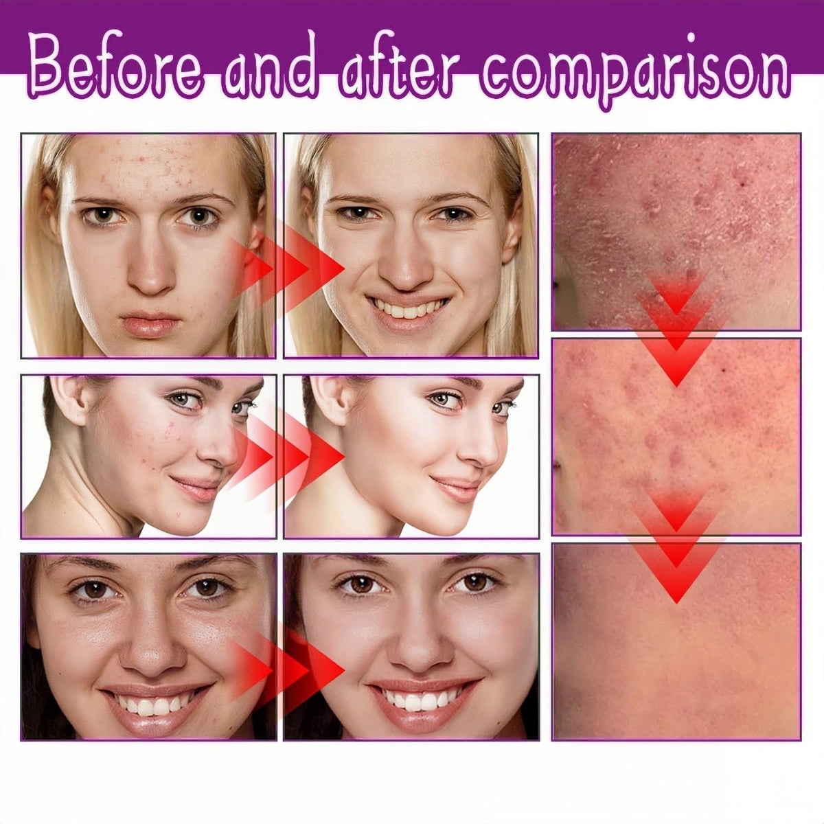 QinZiEn Acid Face Cream,Acid 12% Facial Serum Cream,Acne Treatment for Face,Skincare with Niacinamide & Vitamin C,Acne Scar Removal Cr/eam Night Serum for Face,Dark Spot Serum Crea/m,Acne Moisturiser,20g