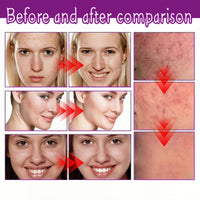 QinZiEn Acid Face Cream,Acid 12% Facial Serum Cream,Acne Treatment for Face,Skincare with Niacinamide & Vitamin C,Acne Scar Removal Cr/eam Night Serum for Face,Dark Spot Serum Crea/m,Acne Moisturiser,20g
