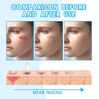 Jinjiar Scar Cream,Scar Removal Cream,Advanced Scar Gel for Old and New Scars,Skin Repair Cream for Old and New Scars,Scar Erase,Acne Scar Treatment,Scar Cream After Surgery,Scar Removalscar Cream for Face