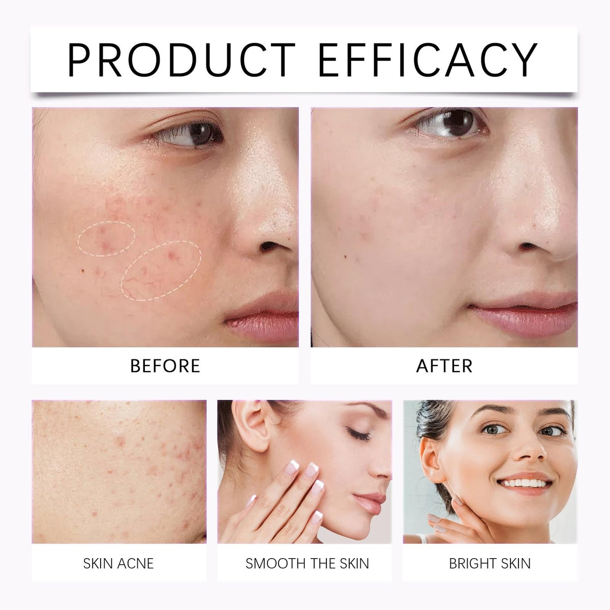 QinZiEn Acid Face Cream,Acid 12% Facial Serum Cream,Acne Treatment for Face,Skincare with Niacinamide & Vitamin C,Acne Scar Removal Cr/eam Night Serum for Face,Dark Spot Serum Crea/m,Acne Moisturiser,20g