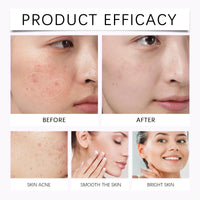 QinZiEn Acid Face Cream,Acid 12% Facial Serum Cream,Acne Treatment for Face,Skincare with Niacinamide & Vitamin C,Acne Scar Removal Cr/eam Night Serum for Face,Dark Spot Serum Crea/m,Acne Moisturiser,20g