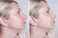 Rapid Acne Scar Treatment Cream - 24-Hour Fast Spot Reduction, Anti Acne Formula, Sensitive Skin Safe, Includes Fast Acne Scar Removal, Moisturiser, Deep Pore Cleansing - 30ml