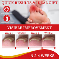 Ingrown Toenail Treatment Drop, Cuticle Care Oils for Ingrown Toenails, Trimming Toenail Softening Drops, Natural Ingrown Toenail Correction, Fungal Nail Treatment, Nail Growth Treatment, 30ml