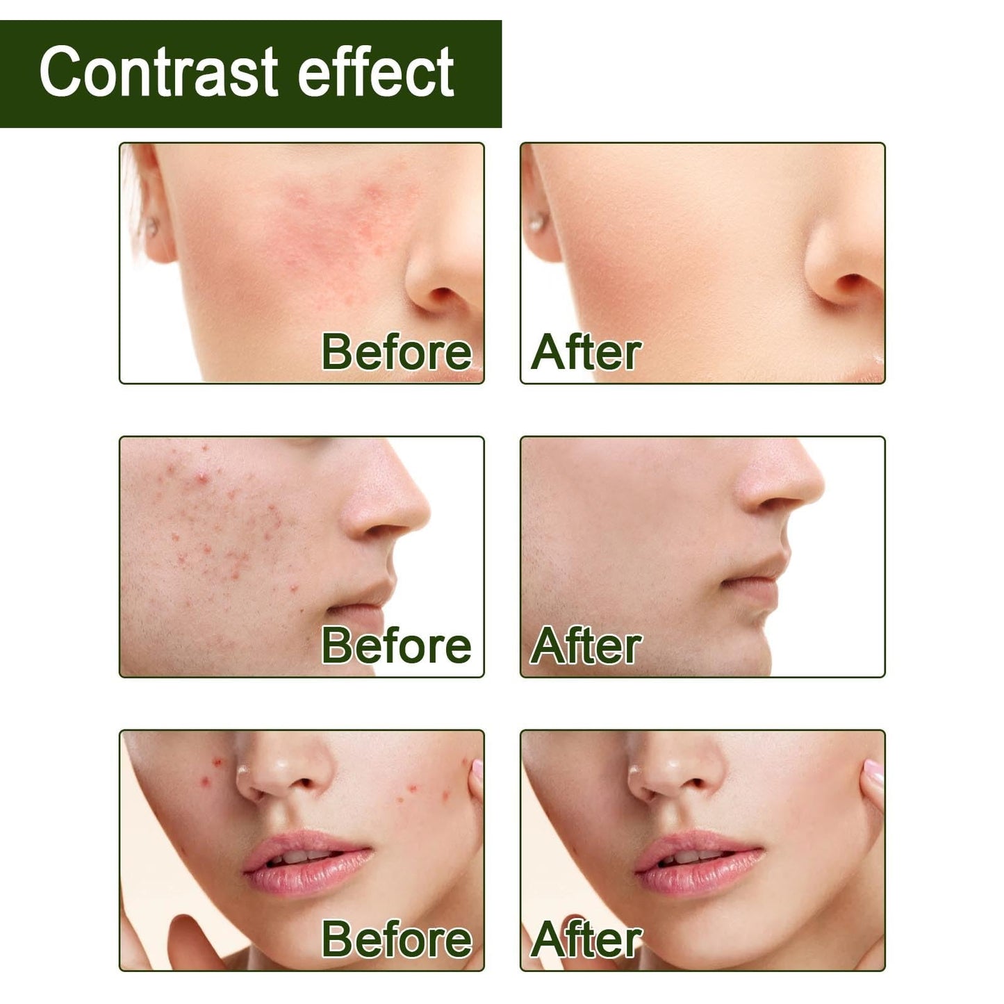 50g Salicylic Acid Acne Cream,3% BHA Spot Cream for Acne,Anti Redness Crea-m for Face,Ac-ne Scar Removal Cre-am,Pimple Cre-am for Redness,Moisturizing Face Cr-eam for Women,Dark Spot Remover for F-ace