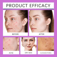 QinZiEn Acid Face Cream,Acid 12% Facial Serum Cream,Acne Treatment for Face,Skincare with Niacinamide & Vitamin C,Acne Scar Removal Cr/eam Night Serum for Face,Dark Spot Serum Crea/m,Acne Moisturiser,20g
