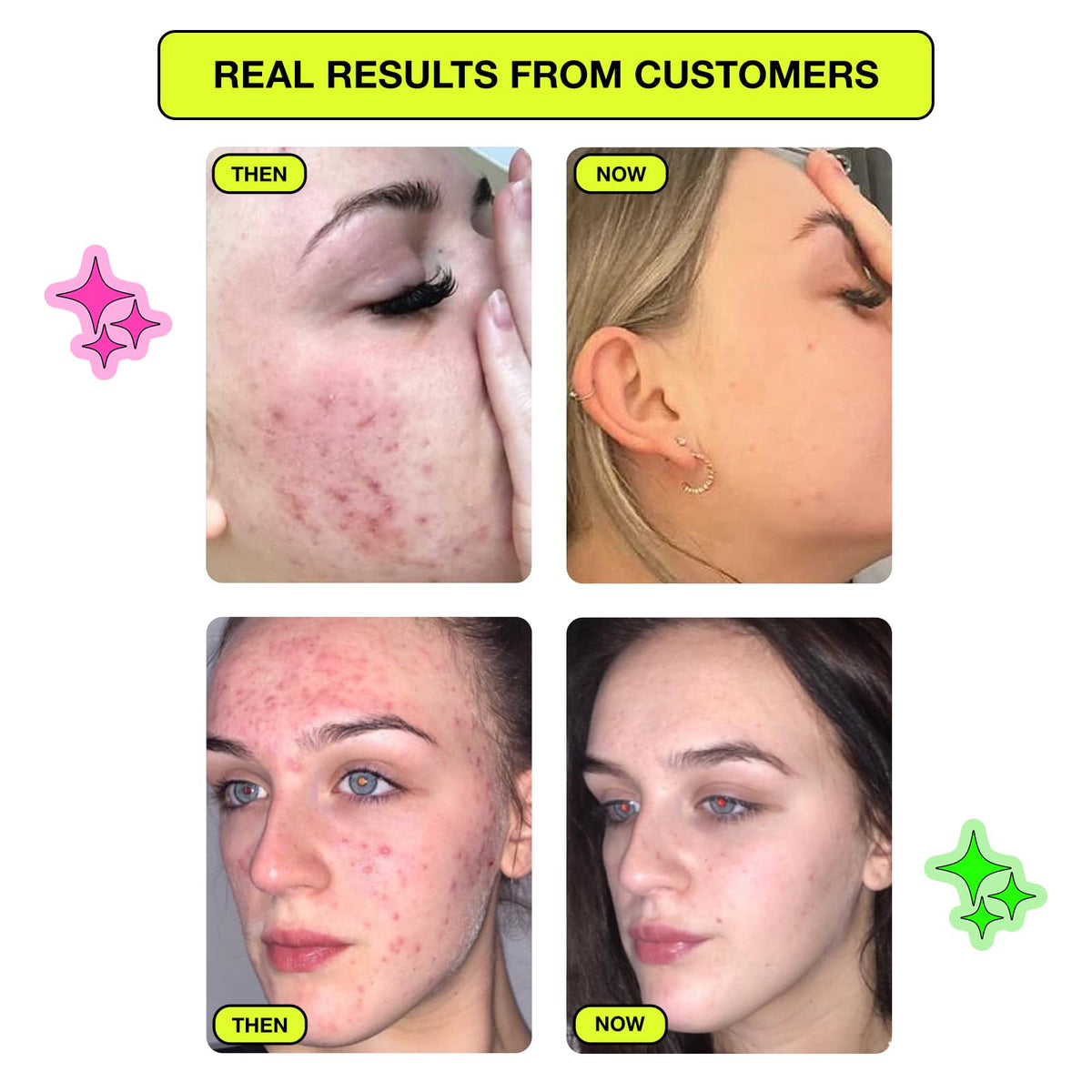 Carbon Theory Supacylic Face Serum - Salicylic Acid Serum - Targets Blemishes, Dry Skin - Acne Treatment & Blemish Treatment - Vegan Facial Exfoliator Serum - 30ml