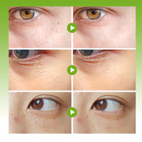 ShunJian Milia Remover, Milia Removal Cream & Brightening Eye Cream, Relieves Fat Par/ticles & Bumps, Milia Treatment for Eye & Face, Wrinkles Remover & Dark Circles Treatment, Firming & Moisturizing