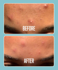 Absorbzit - The Overnight Hydrocolloid Pimple Patches, Thick & Durable Spot Patches, Vegan & Cruelty-Free Acne Treatment - 36 Nighttime Patches