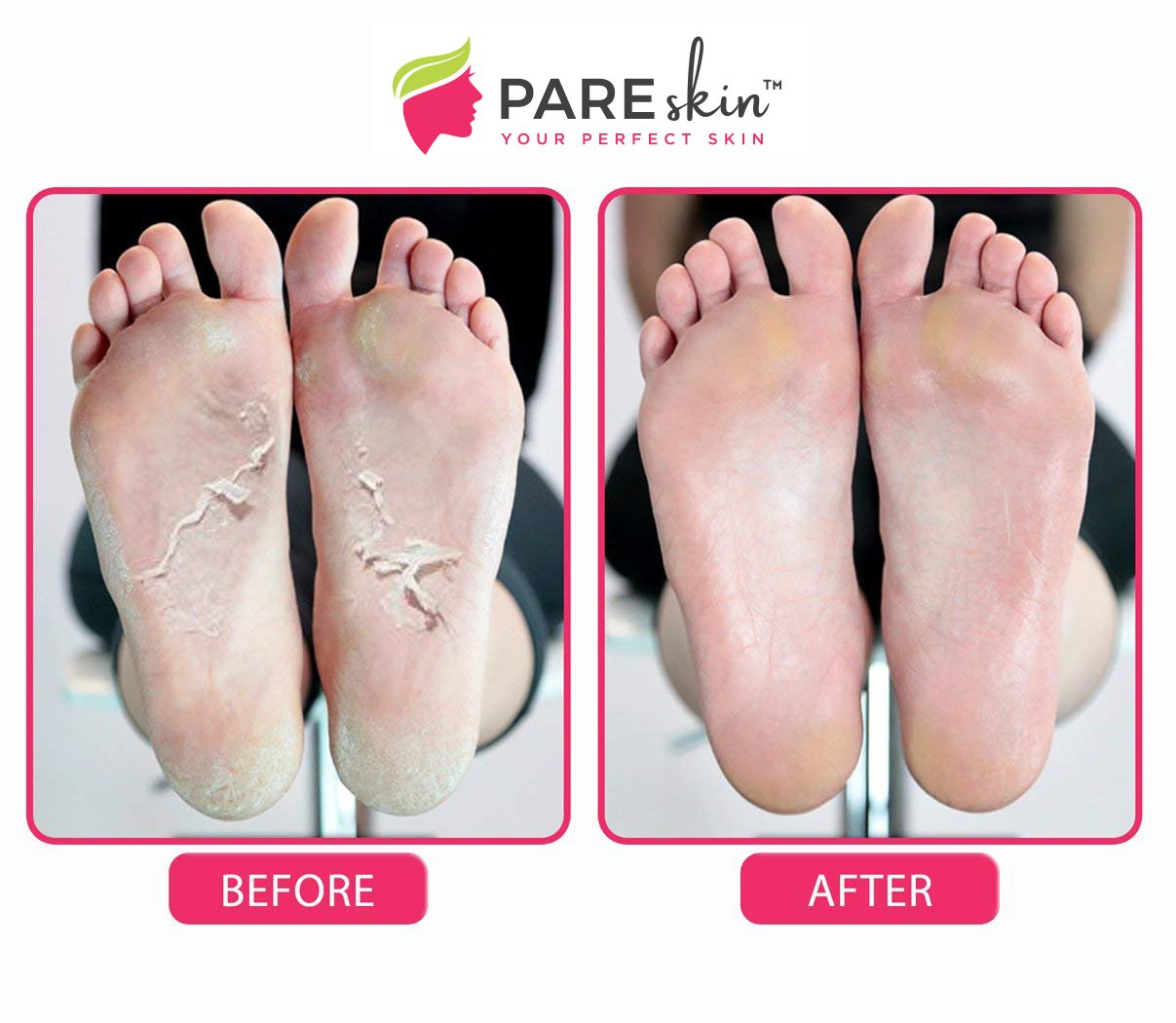 Pareskin [ 2 Pack ] Foot Peel Mask - Cracked Heels Repair for Dry Callus Dead Skin - Exfoliating Peel Remover for Baby Soft Feet
