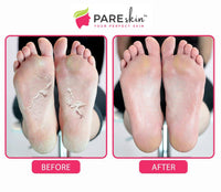 Pareskin [ 2 Pack ] Foot Peel Mask - Cracked Heels Repair for Dry Callus Dead Skin - Exfoliating Peel Remover for Baby Soft Feet