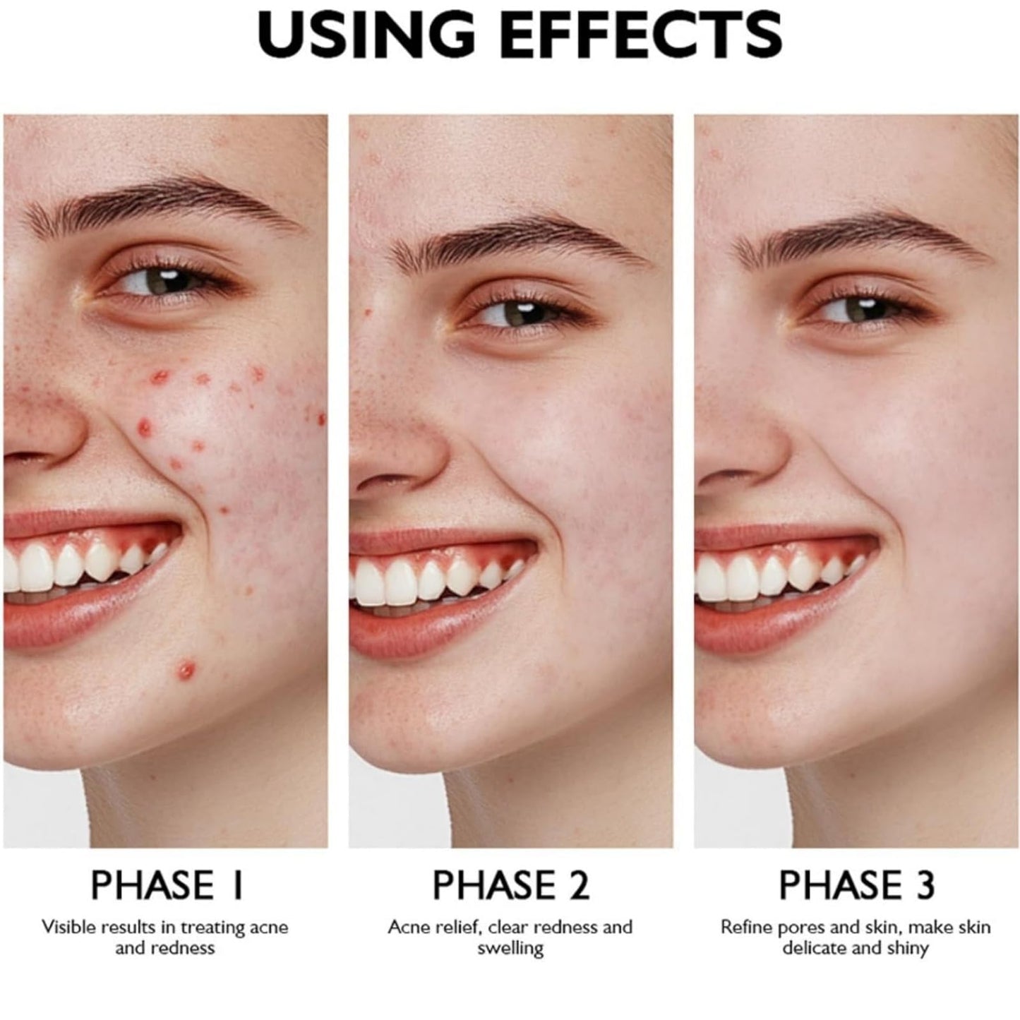 SingHao Aze-laic Acid 15% Acne Tratment Gel,15% Acid Acne Treatment Gel for Face,Azel-aic Acid Cream for Face,Acid Facial Serum,Aze-laic Ac/id Serum Cream with Niacinamide & Vitamin C,Anti Acne G/el for Spot