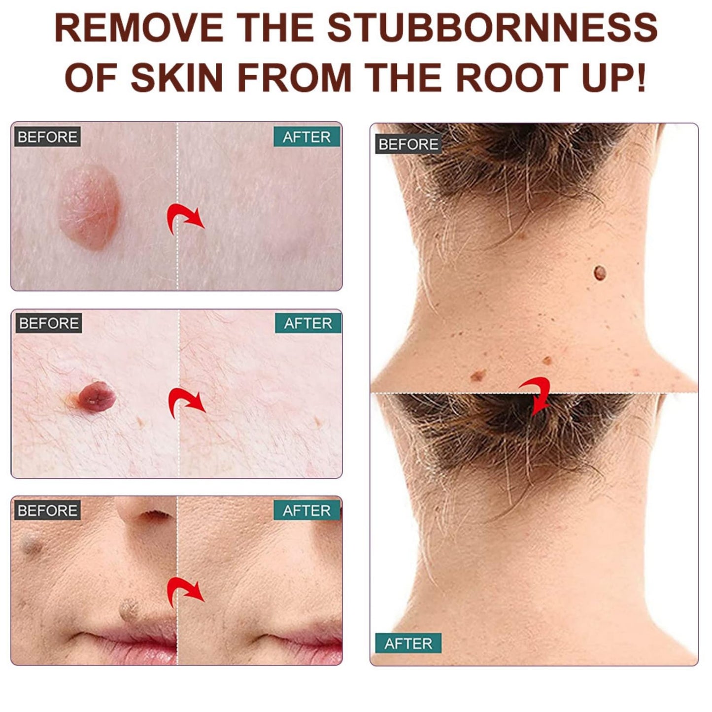 Wart Remover Pen,Mole and Wart Removal Pen,Dark Spots Treatments Mole Wa/rt Remover for Face,Liquid Pe/n Stops Regrowth Skin Care,Easy Removal P/en,Wa/rt Remov/ers for Sk/in Type,Verruca Treatments
