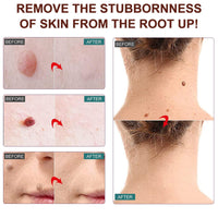Wart Remover Pen,Mole and Wart Removal Pen,Dark Spots Treatments Mole Wa/rt Remover for Face,Liquid Pe/n Stops Regrowth Skin Care,Easy Removal P/en,Wa/rt Remov/ers for Sk/in Type,Verruca Treatments