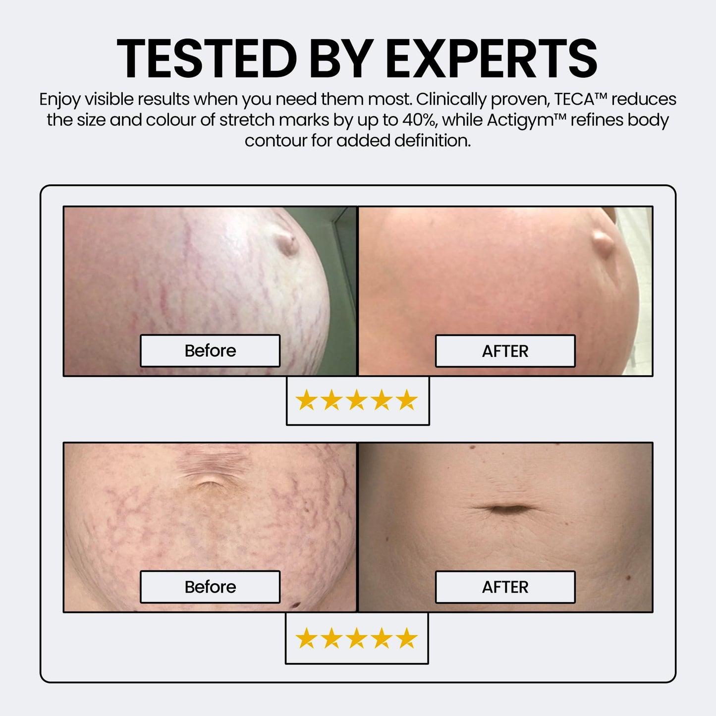 Stria Lab Stretch Marks Removal Cream for Women & Men, 12 Week Cycle – Peptide and Vitamins Stretch Mark & Scar Cream for Reduction in Stretch Marks, Improves Elasticity and Firmness. Award Winning.