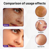 Ninnyi 30g Advanced Anti-Hyperpigmentation Cream, Dark Spots Remover Cream with Facial Massage Board