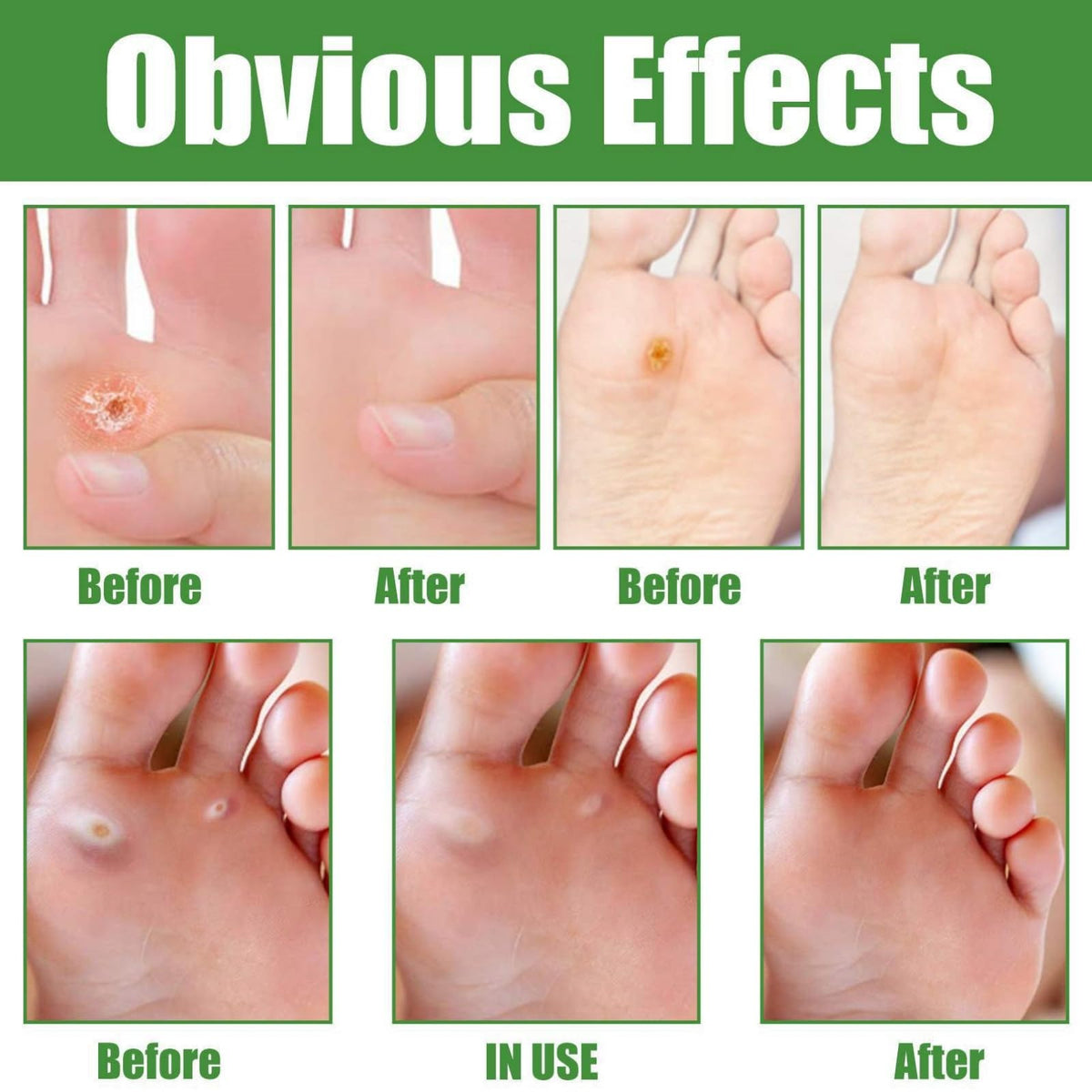 ChunBin 30PCS Verruca Treatment,Wart Treatment Patch,Wart Remover,Plantar Wart Remover for Hands,Pain Free Plasters for Adults,Stops Wart Regrowth,Repair Skin,Easy to Use,Non-Irritating Effective,Pain Relief