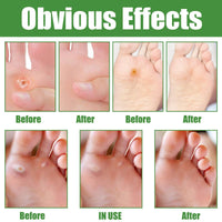 ChunBin 30PCS Verruca Treatment,Wart Treatment Patch,Wart Remover,Plantar Wart Remover for Hands,Pain Free Plasters for Adults,Stops Wart Regrowth,Repair Skin,Easy to Use,Non-Irritating Effective,Pain Relief