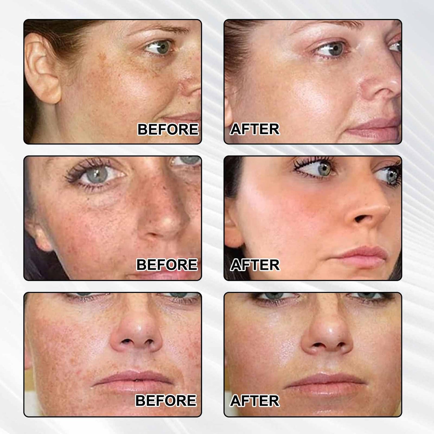 Mxlfdc Dark Spot Remover for Face，-Age Spot Remover -Hyperpigmentation Treatment-Sun Spots and Melasma Treatment Cream for Face, Pigmentation Freckle Removal Cream
