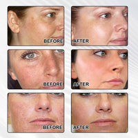 Mxlfdc Dark Spot Remover for Face，-Age Spot Remover -Hyperpigmentation Treatment-Sun Spots and Melasma Treatment Cream for Face, Pigmentation Freckle Removal Cream