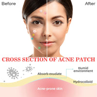 Home Holic Star 480 Pimple Patches Spot Patches Acne Treatment Absorbing Cover Invisible Blemish Cover Spot Sticker for Fast Acting Skincare